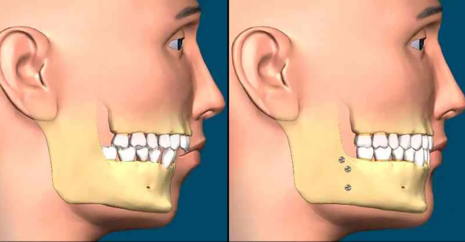Dental Straightening Surgery 2